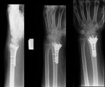 Wrist Fracture